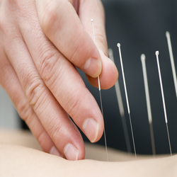 TCM Acupuncture